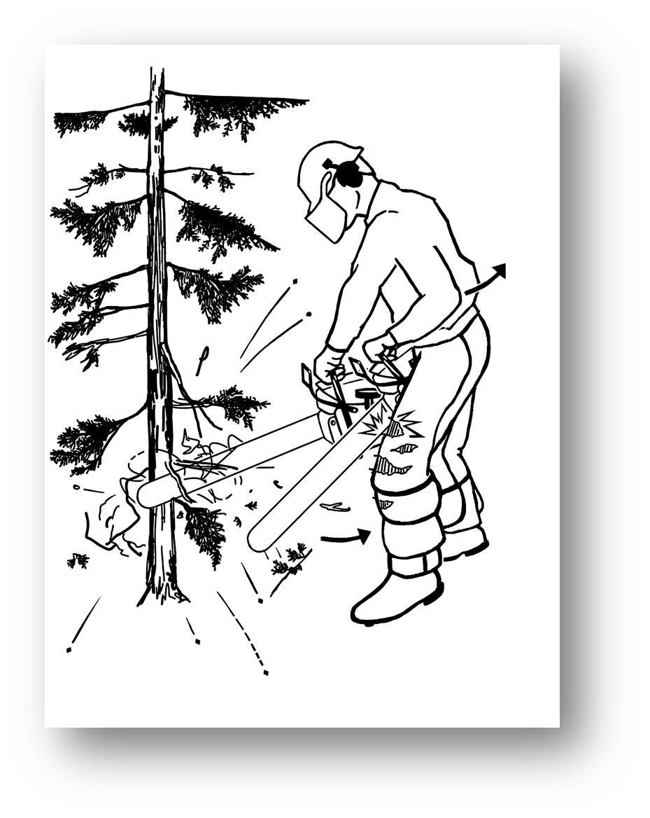 Chainsaw Injury Illustration